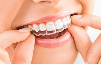 close-up of woman's mouth, putting on an Invisalign guard