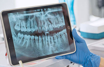 digital x-ray of teeth being shown on a tablet