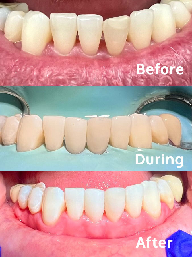 Bioclear treatment on bottom teeth before, during and after photos. "Black triangles" have been significantly reduced.
